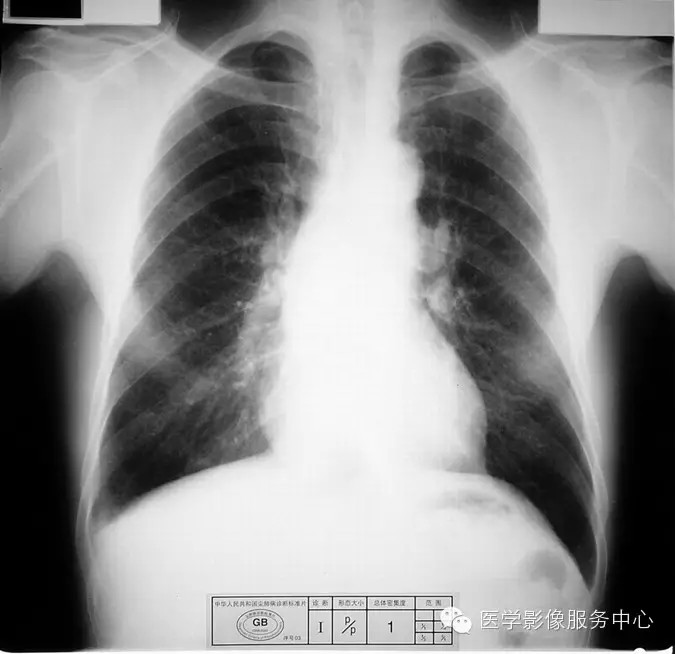 各期尘肺标准片及解读