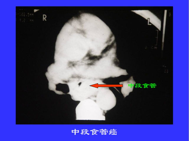 胸部CT阅读与诊断
