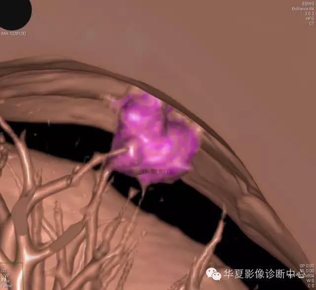 【病例学习】