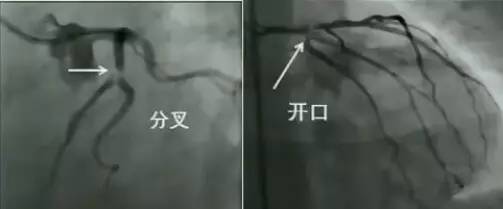 冠脉造影阅片要领