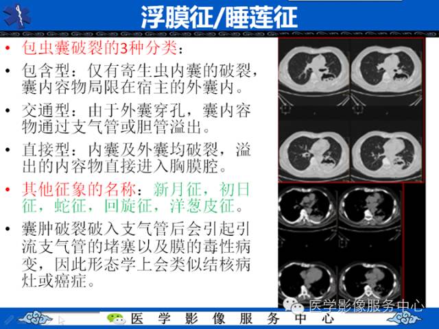 住院医师必知的12个HRCT征象