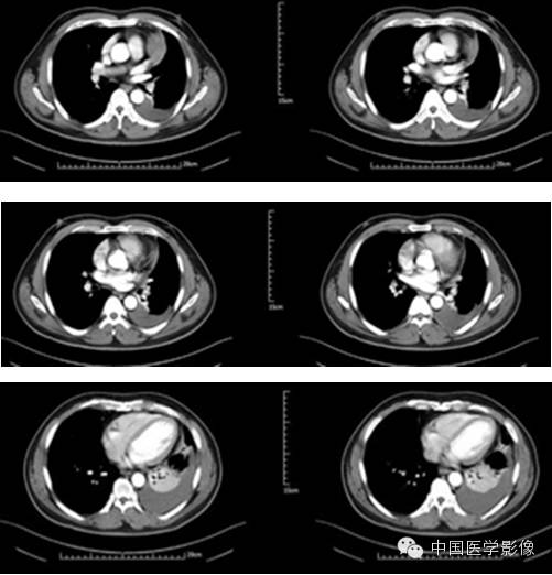 【病例学习】孤立性纤维性肿瘤2例CT影像表现
