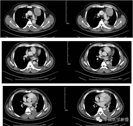 【病例学习】孤立性纤维性肿瘤2例CT影像表现