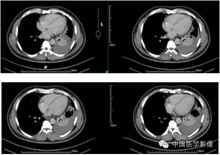 【病例学习】孤立性纤维性肿瘤2例CT影像表现