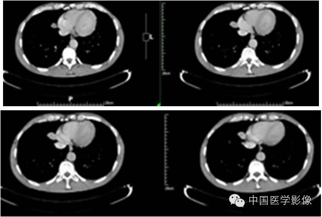 【病例学习】孤立性纤维性肿瘤2例CT影像表现