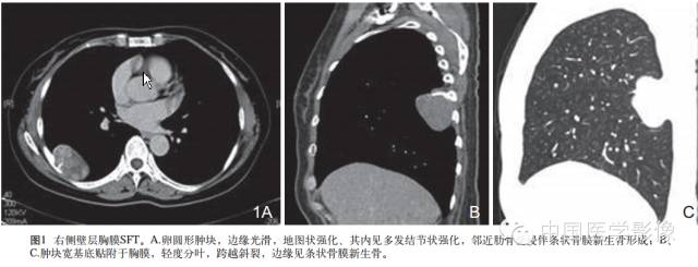 【病例学习】孤立性纤维性肿瘤2例CT影像表现