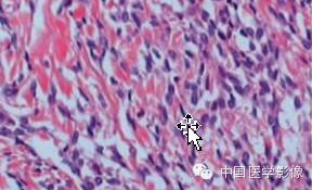 【病例学习】孤立性纤维性肿瘤2例CT影像表现