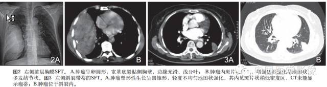 【病例学习】孤立性纤维性肿瘤2例CT影像表现