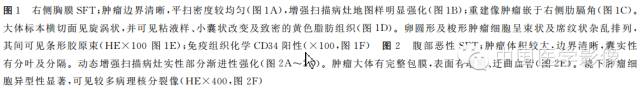 【病例学习】孤立性纤维性肿瘤2例CT影像表现
