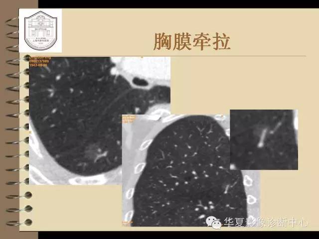 【PPT】早期肺癌影像诊断
