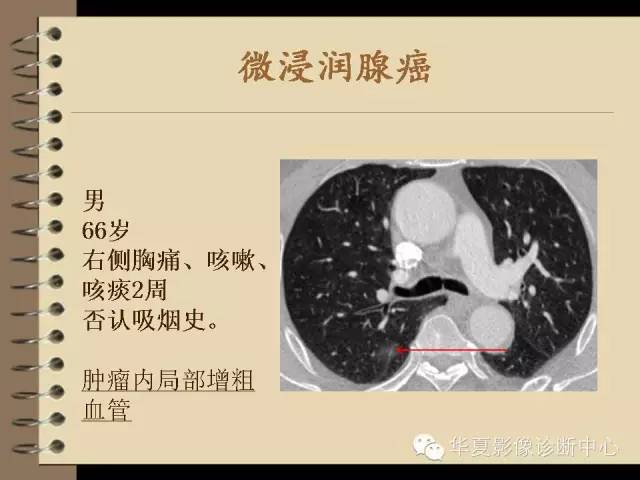【PPT】早期肺癌影像诊断