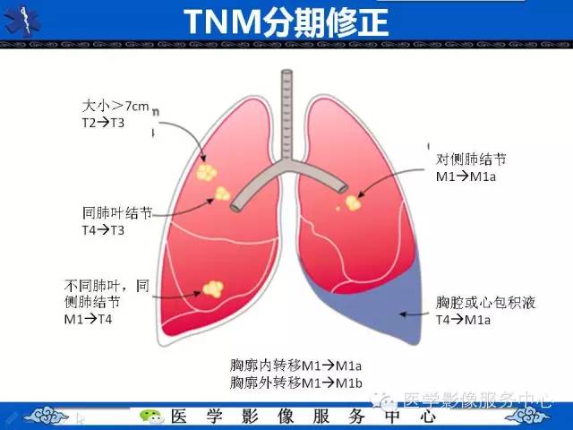 【PPT】亚实性肺结节—影像诊断医师和临床医师必知内容