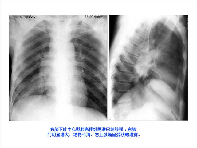 100张典型X线图片