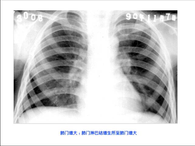 100张典型X线图片