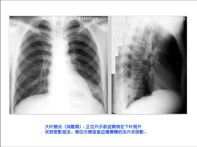 100张典型X线图片
