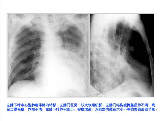 100张典型X线图片