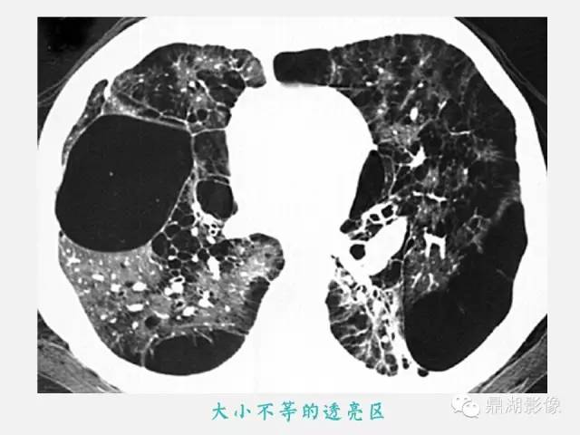 【PPT】肺内多发空洞和囊性病变诊断与鉴别诊断