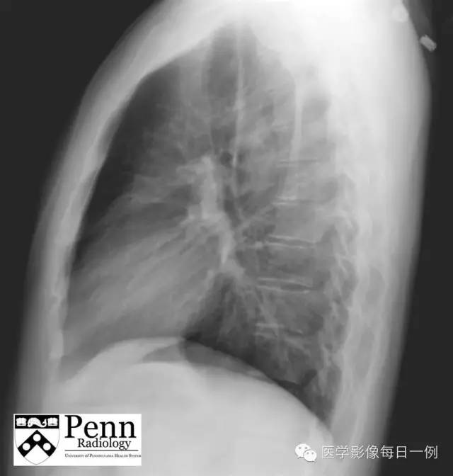 【病例】前降支重度狭窄1例影像表现