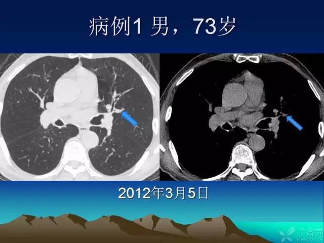 【PPT】早期肺癌易漏诊征象分析