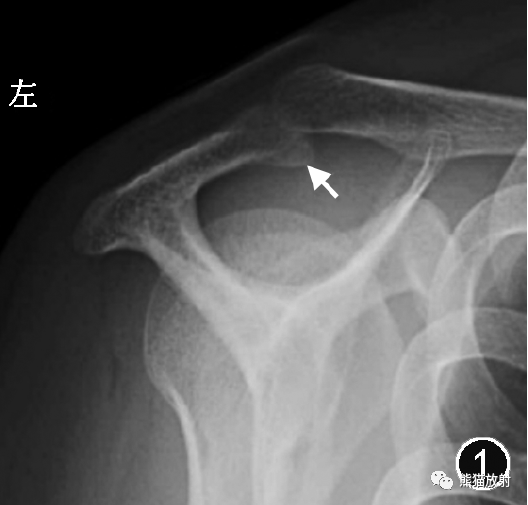 肩峰下撞击综合征的临床及影像表现