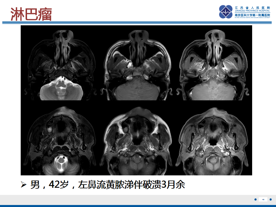 【PPT】鼻腔鼻窦鳞状细胞癌-41