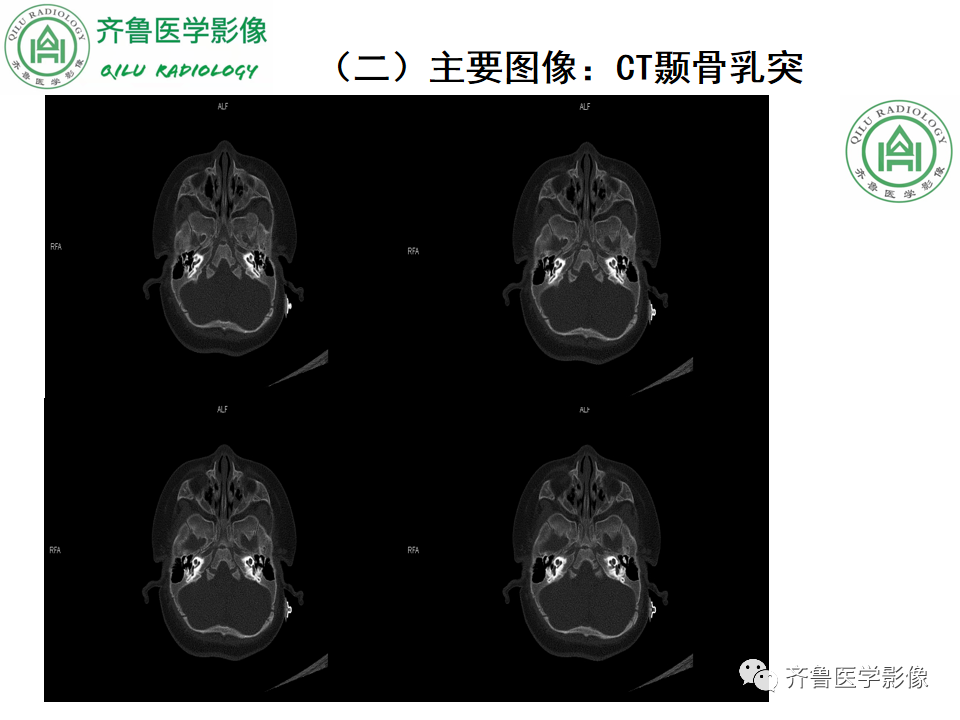 【PPT】内耳畸形—耳部病变早读片病例-8