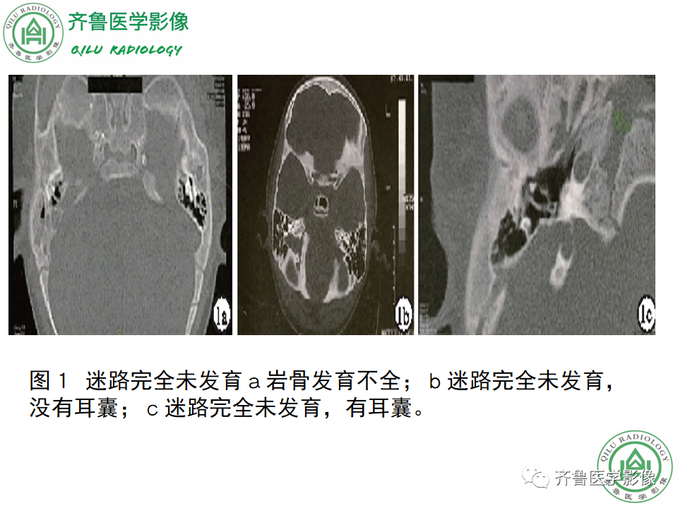 【PPT】内耳畸形—耳部病变早读片病例-22