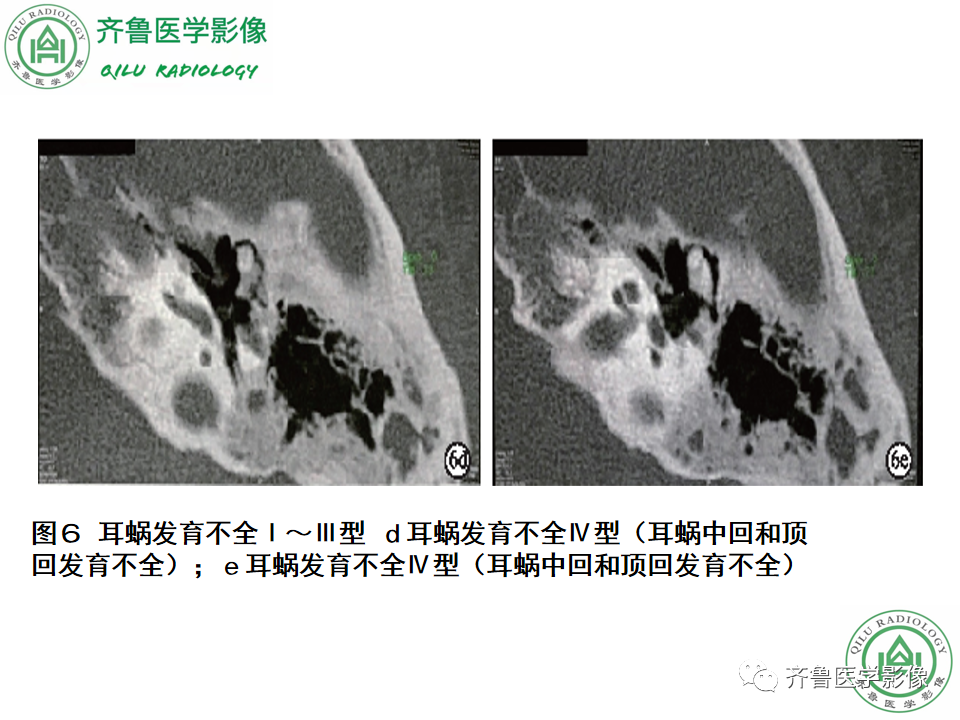 【PPT】内耳畸形—耳部病变早读片病例-29