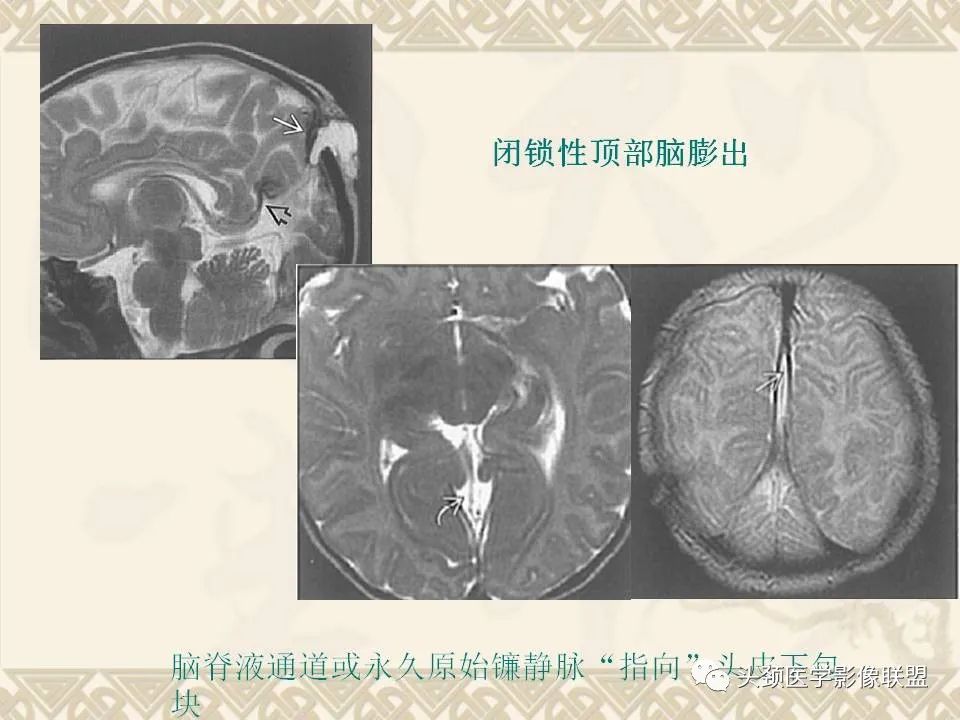 【PPT】颅骨肿瘤的影像学诊断与鉴别诊断-15