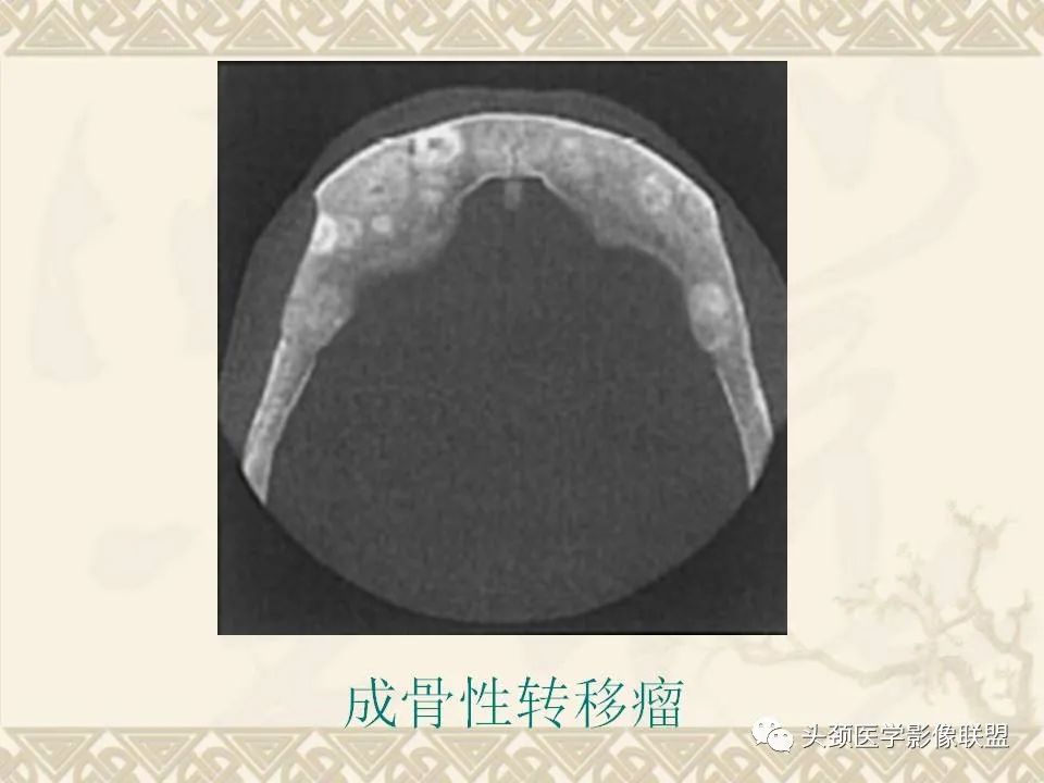 【PPT】颅骨肿瘤的影像学诊断与鉴别诊断-65