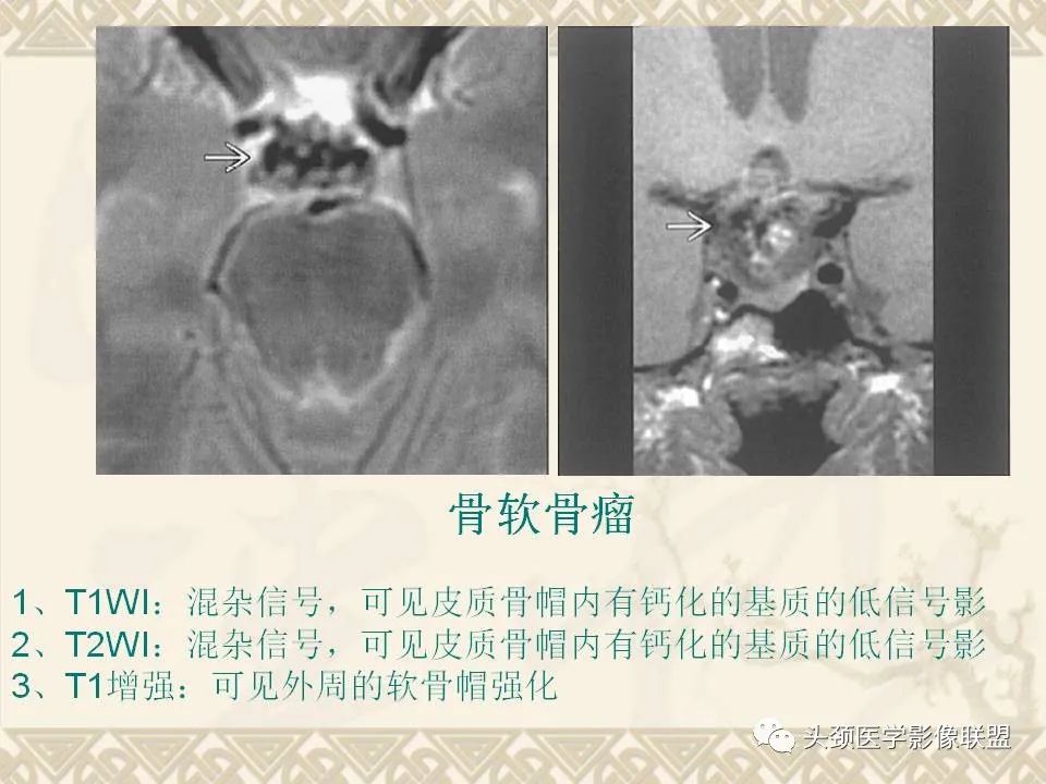 【PPT】颅骨肿瘤的影像学诊断与鉴别诊断-91