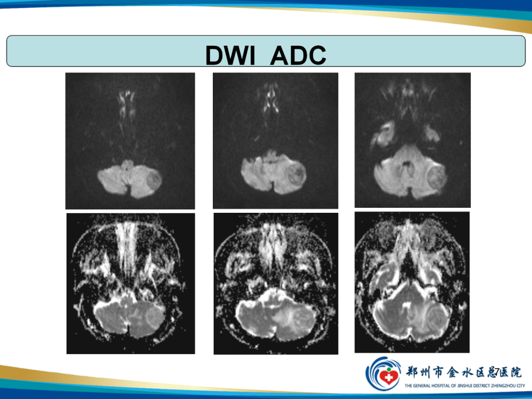 【PPT】非典型脑膜瘤影像学诊断-7