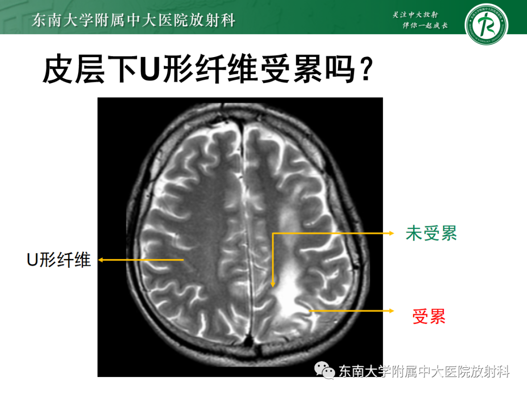 【PPT】皮层下U形纤维受累常见病变-20