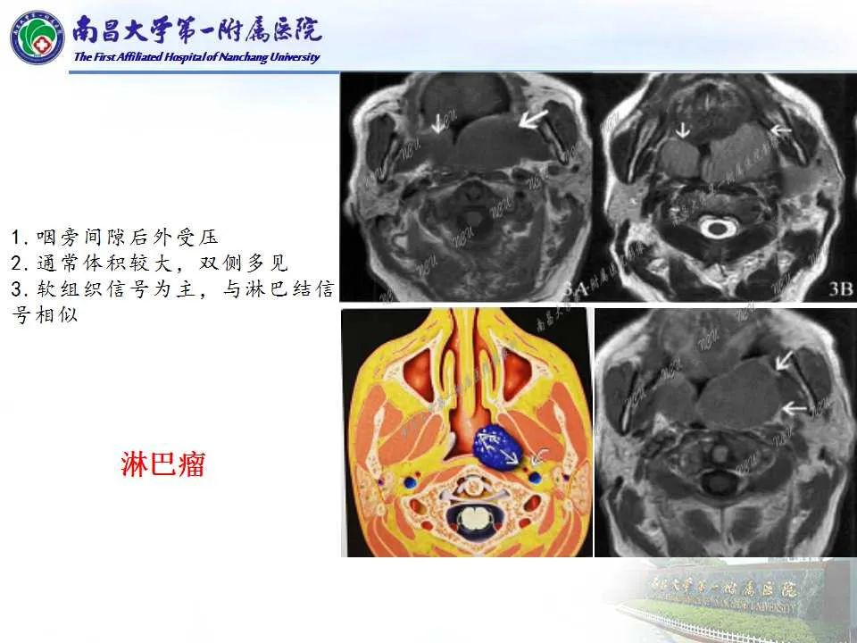 【PPT】咽旁间隙——你别动-22