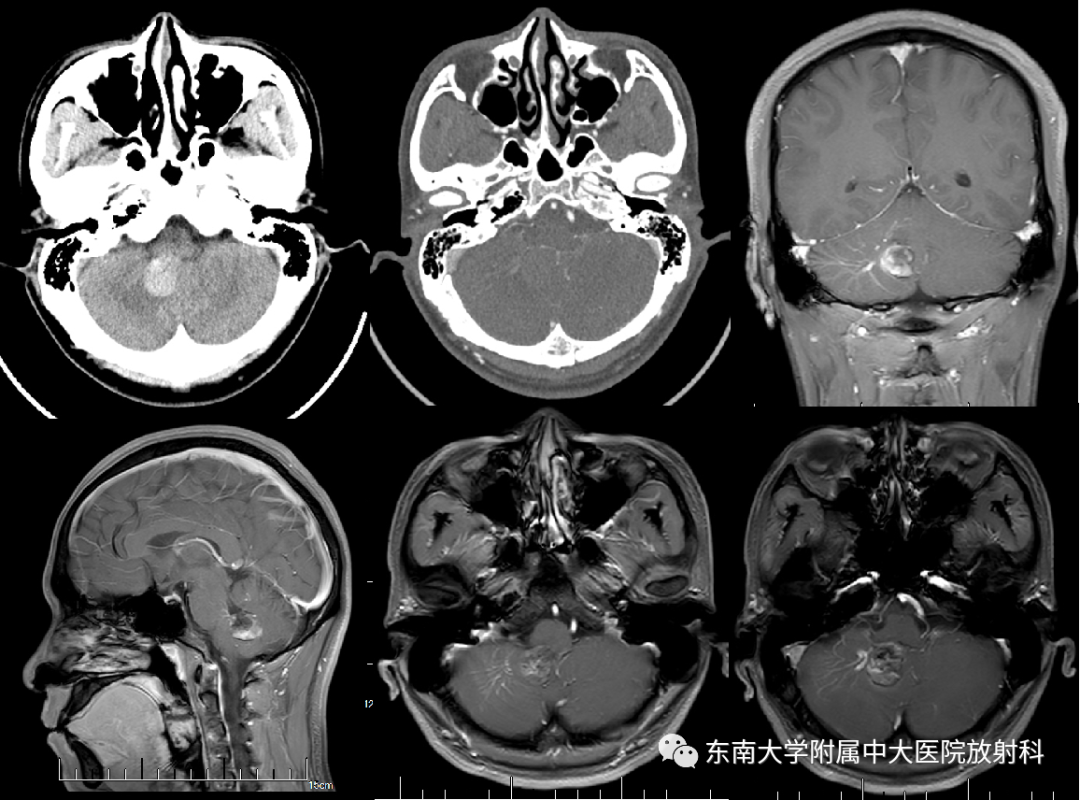 【PPT】颅内海绵状血管畸形-1