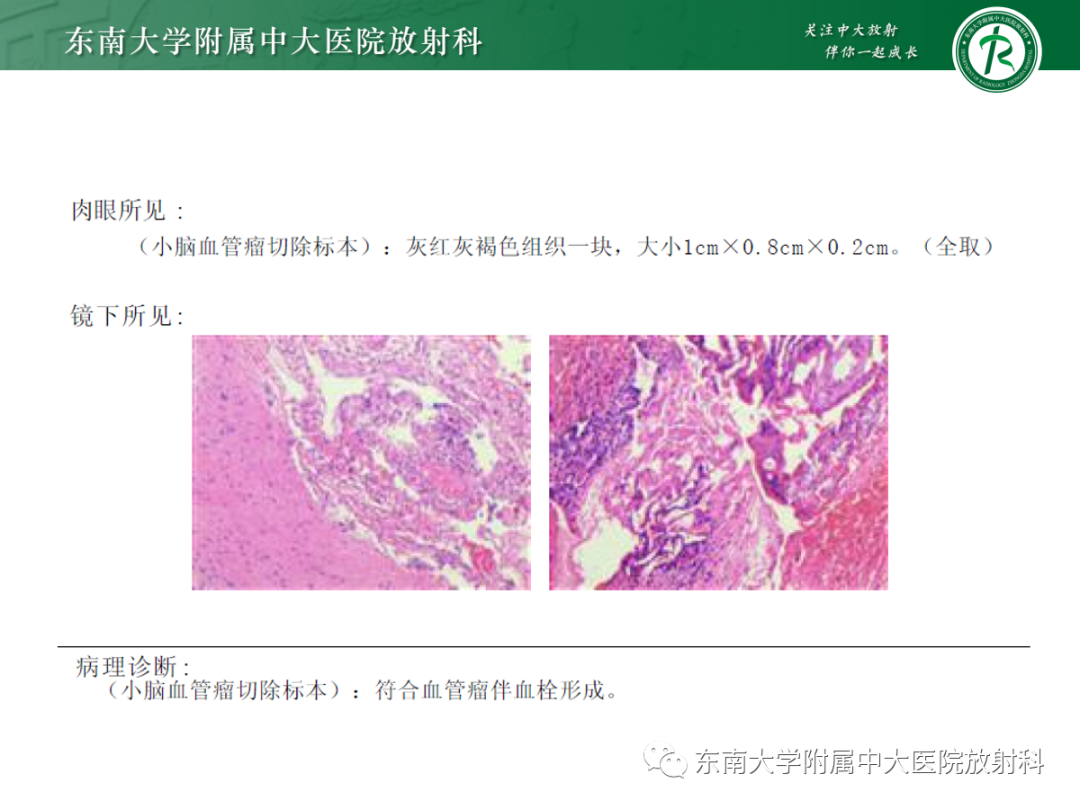 【PPT】颅内海绵状血管畸形-3