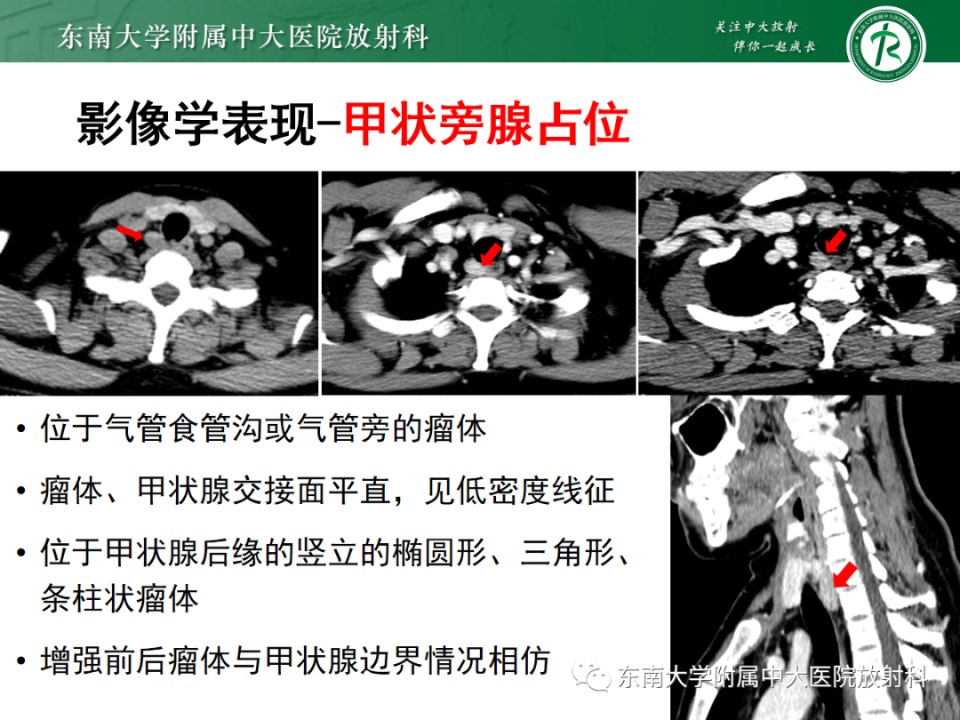 【PPT】原发性甲状旁腺功能亢进-17