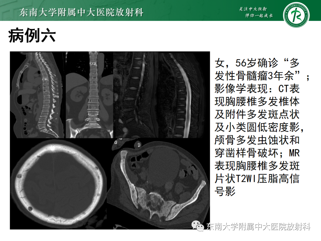 【PPT】原发性甲状旁腺功能亢进-33