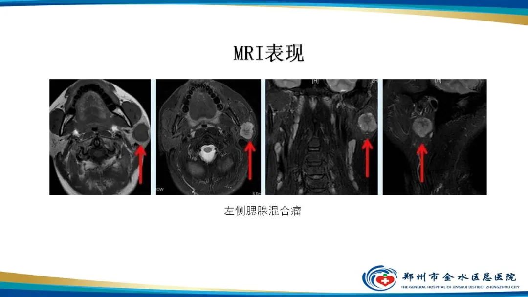 【病例】腮腺多形性腺瘤1例CT影像-23