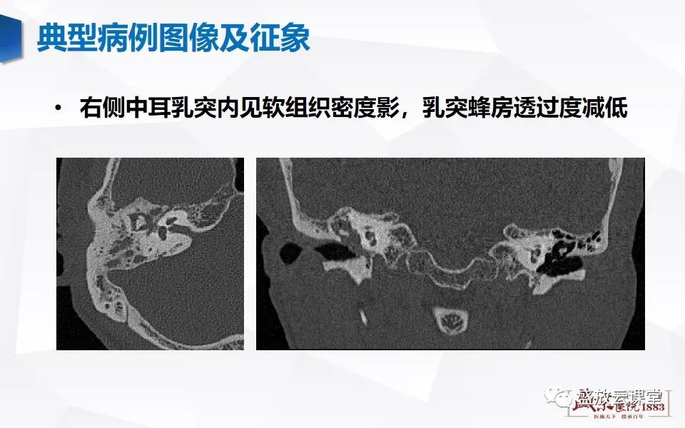 【PPT】中耳乳突解剖及炎症-4