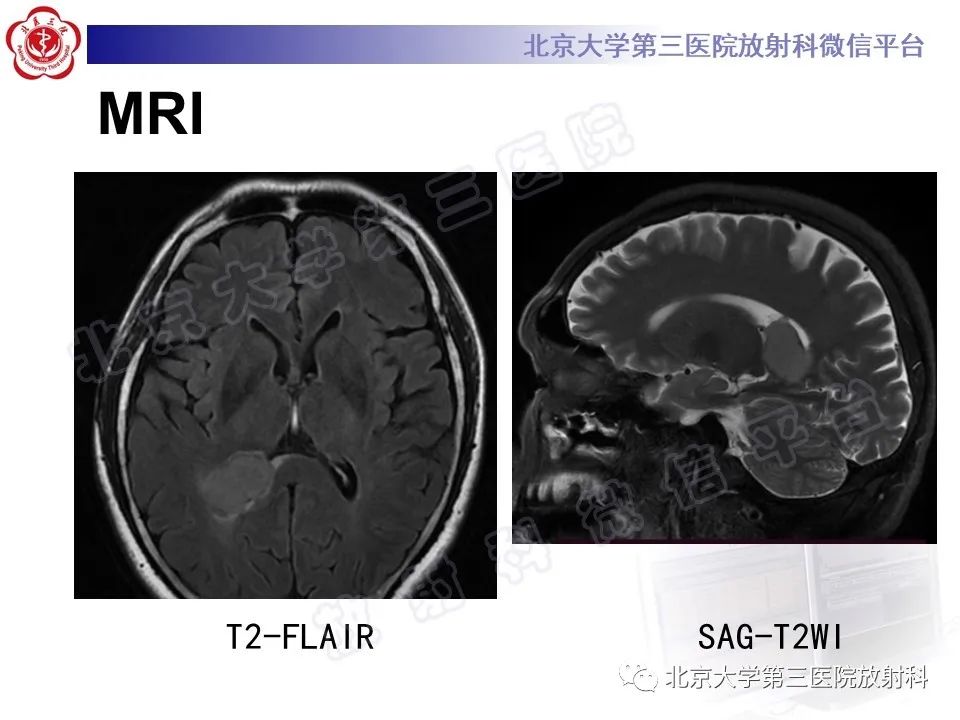 【PPT】脑室内脑膜瘤-5