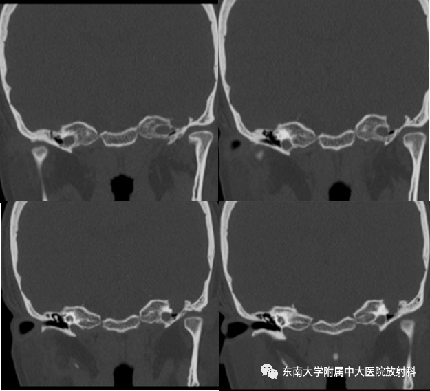 【PPT】面神经解剖及常见病影像学表现-2