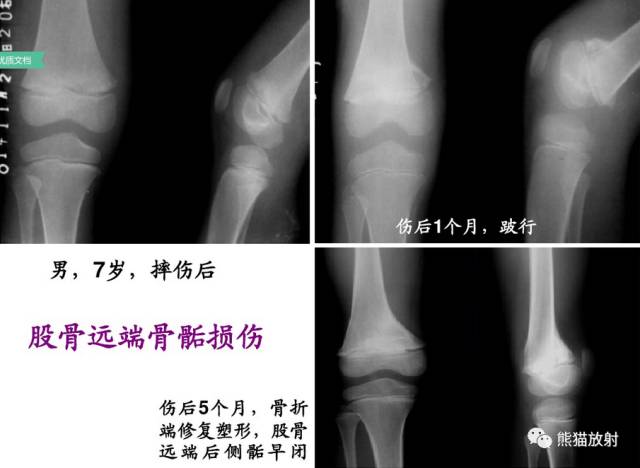 骨骺损伤的分型及影像表现-22