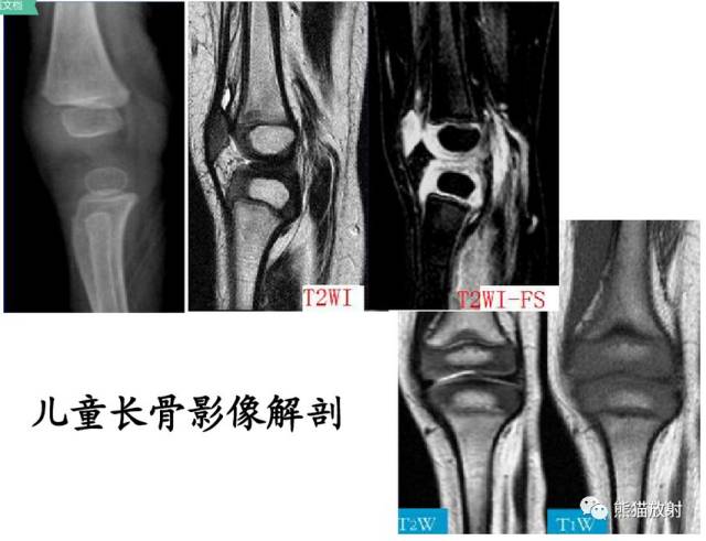 骨骺损伤的分型及影像表现-23