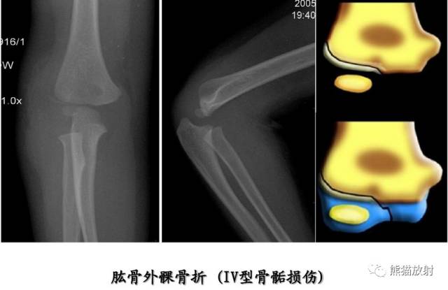 骨骺损伤的分型及影像表现-31