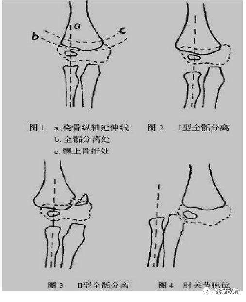 骨骺损伤的分型及影像表现-44