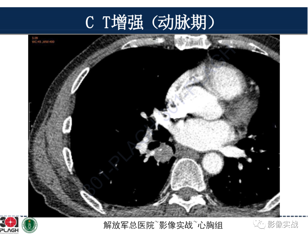 【病例】肺浸润性腺癌1例CT-21