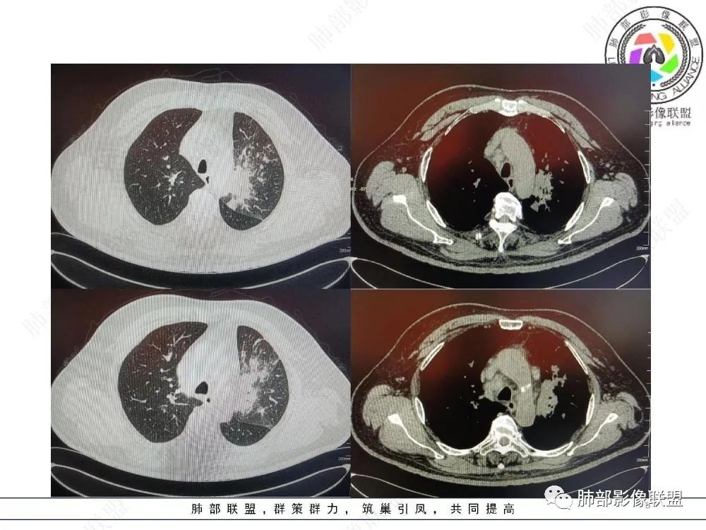 【病例】肺部这样的片状影，你是否能一锤定音？-5