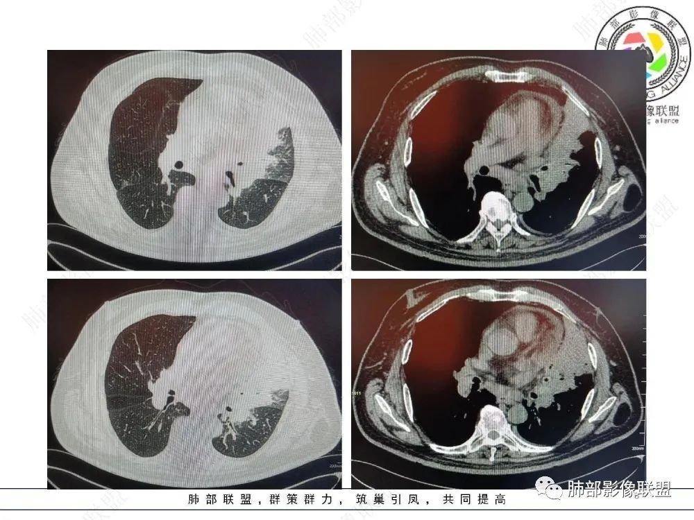 【病例】肺部这样的片状影，你是否能一锤定音？-8