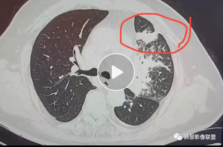 【病例】肺部这样的片状影，你是否能一锤定音？-26